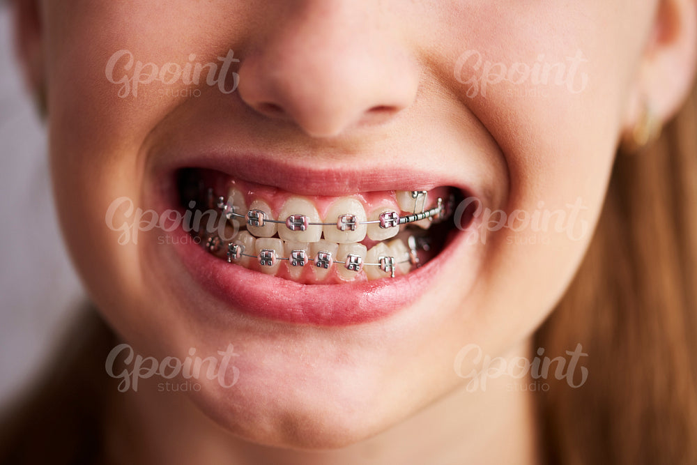 Shot of teeth with braces